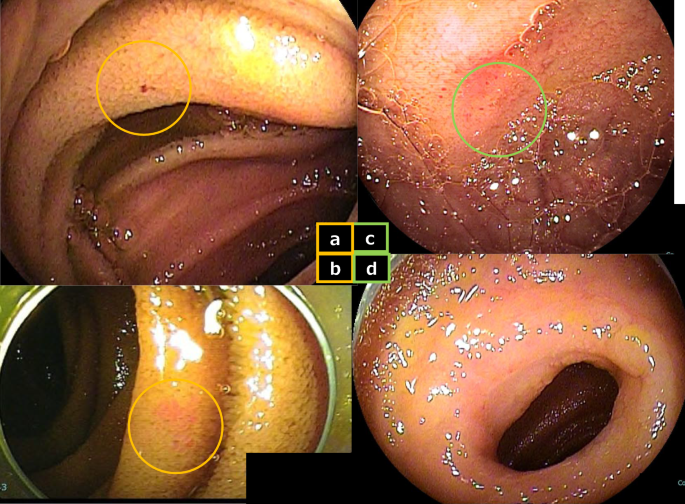 Long-Term Outcomes and Rebleeding Risk Factors in Suspected Small Bowel ...