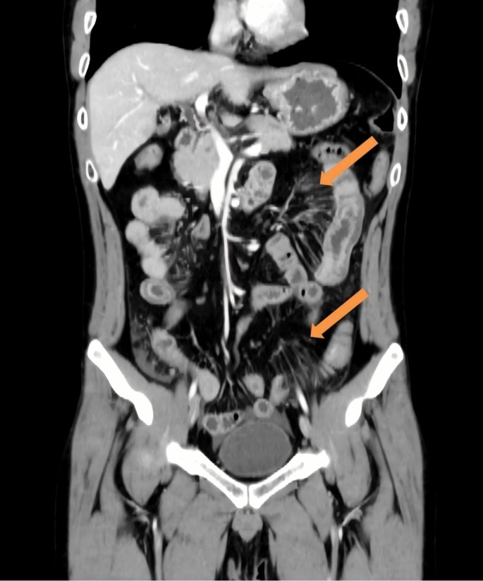 Lupus Mesenteric Vasculitis with Characteristic Computed Tomography ...