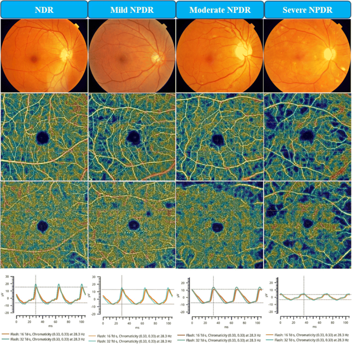 Retinal Vasculature Function Correlation In Non Proliferative Diabetic Retinopathy Springerlink