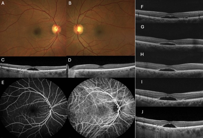 Unilateral best vitelliform macular dystrophy- a case series ...