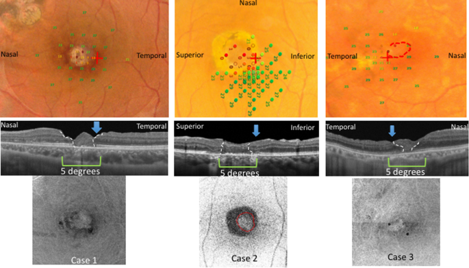 Macular retinal function after autologous retinal transplantation in ...