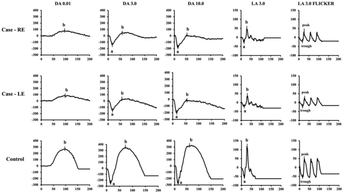 Bilateral non-hereditary foveomacular and peripheral retinoschisis in a ...