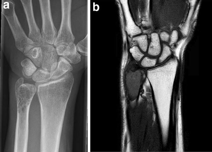 Clear Cell Chondrosarcoma In Von Hippel Lindau Disease Springerlink