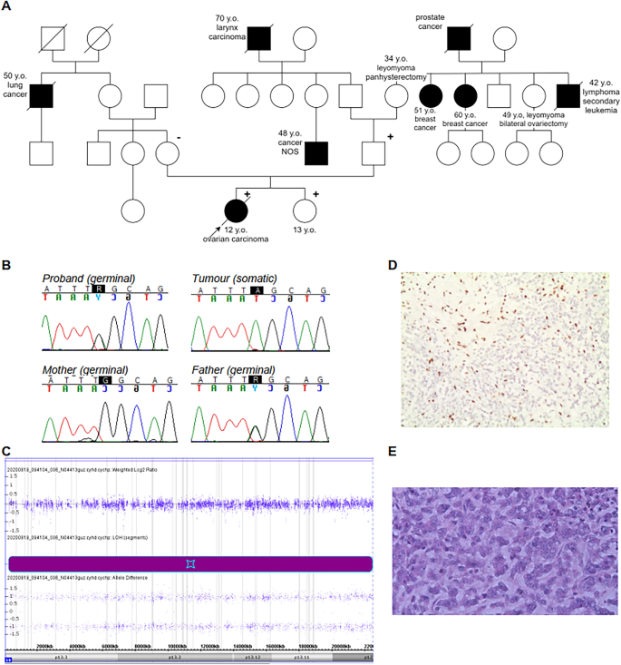 Ovarian Carcinoma In Children With Constitutional Mutation Of Smarca4 Single Family Report And Literature Review Springerlink
