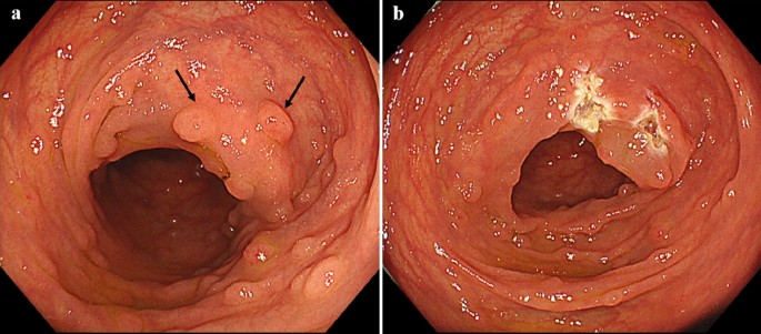 Endoscopic management of familial adenomatous polyposis targeting colorectal lesions greater than 5 mm in size: a single-center retrospective study | Familial Cancer