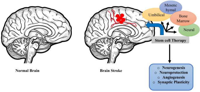 The promise of stem cell therapies for cellular recovery after stroke ...