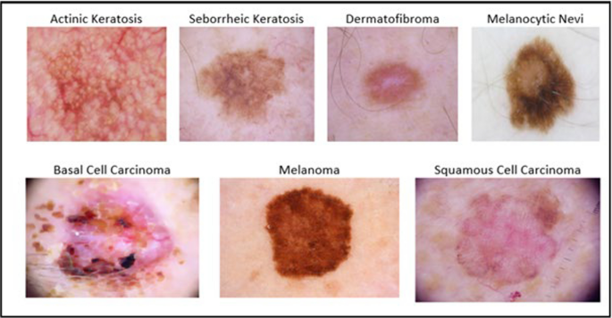 SkinSight: advancing deep learning for skin cancer diagnosis and  classification | Discover Computing