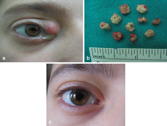 Actinomyces canaliculitis and its surgical treatment | SpringerLink