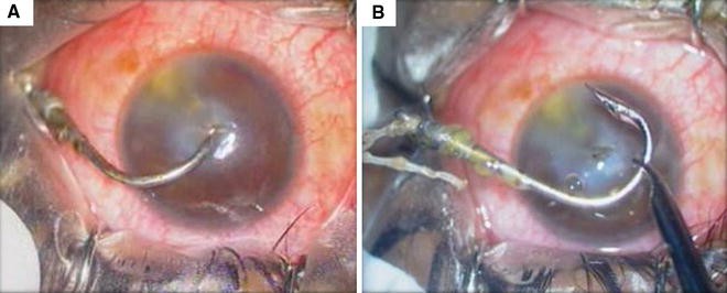 Fish-hook injury of the eye  International Ophthalmology
