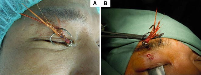 Fish-hook injury of the eye  International Ophthalmology