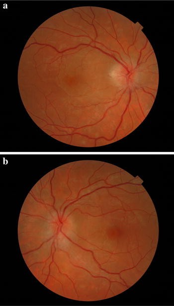 macular edema fundoscopy hegesztés szemkárosodás