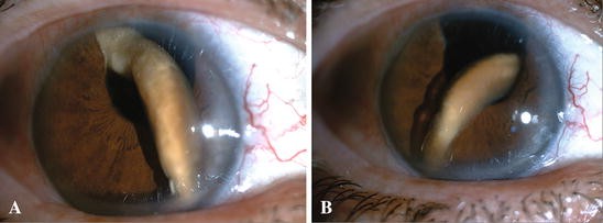 Voorbeeld kalf Kameraad Pupil occlusion due to a large dislocated Soemmering ring in an aphakic eye | SpringerLink Voorbeeld kalf Kameraad Pupil occlusion due to a large dislocated Soemmering ring in an aphakic eye | SpringerLink