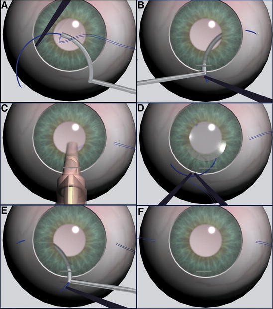 A safe method of ciliary sulcus fixation of foldable intraocular lens using  a ciliary sulcus guide | SpringerLink