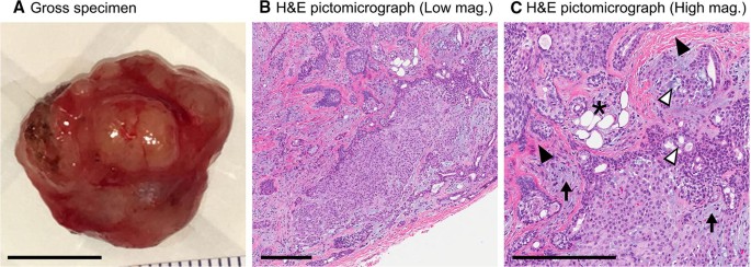 atypical pleomorphic adenoma