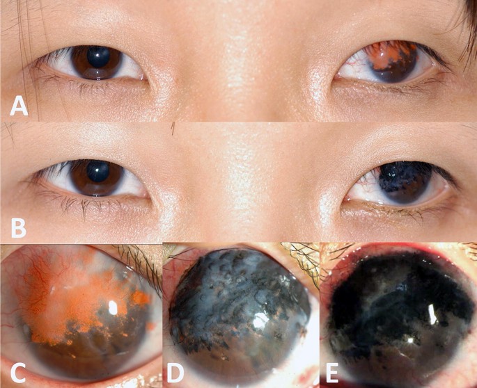 Clinical photograph of the left eye with corneal tattoo The corneal   Download Scientific Diagram