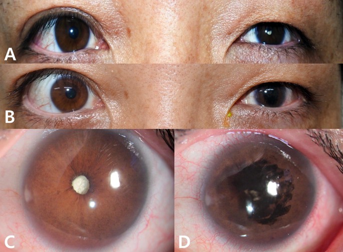 Scleral tattooing  Wikipedia