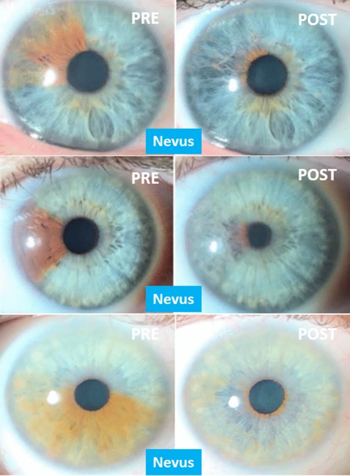 Photoablative cosmetic iridoplasty: effective, safe, and predictable—eye  color change in 1176 eyes | SpringerLink