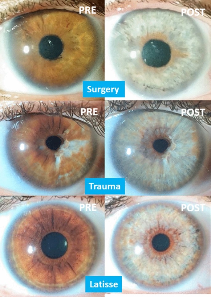 Photoablative cosmetic iridoplasty: effective, safe, and predictable—eye  color change in 1176 eyes | SpringerLink