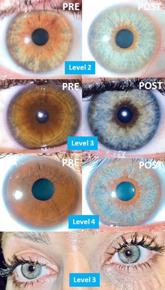 Photoablative cosmetic iridoplasty: effective, safe, and predictable—eye  color change in 1176 eyes | SpringerLink