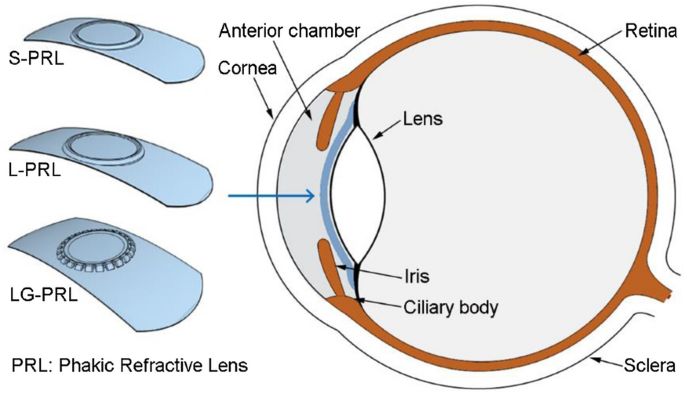 Assessment of biosafety and implantation feasibility of novel phakic  refractive lens | SpringerLink