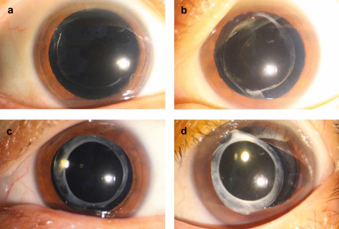 Ocular characteristics and outcomes of phacoemulsification in patients ...
