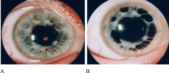 Ppm In Eye Manifestations of persistent pupillary membrane | International ...