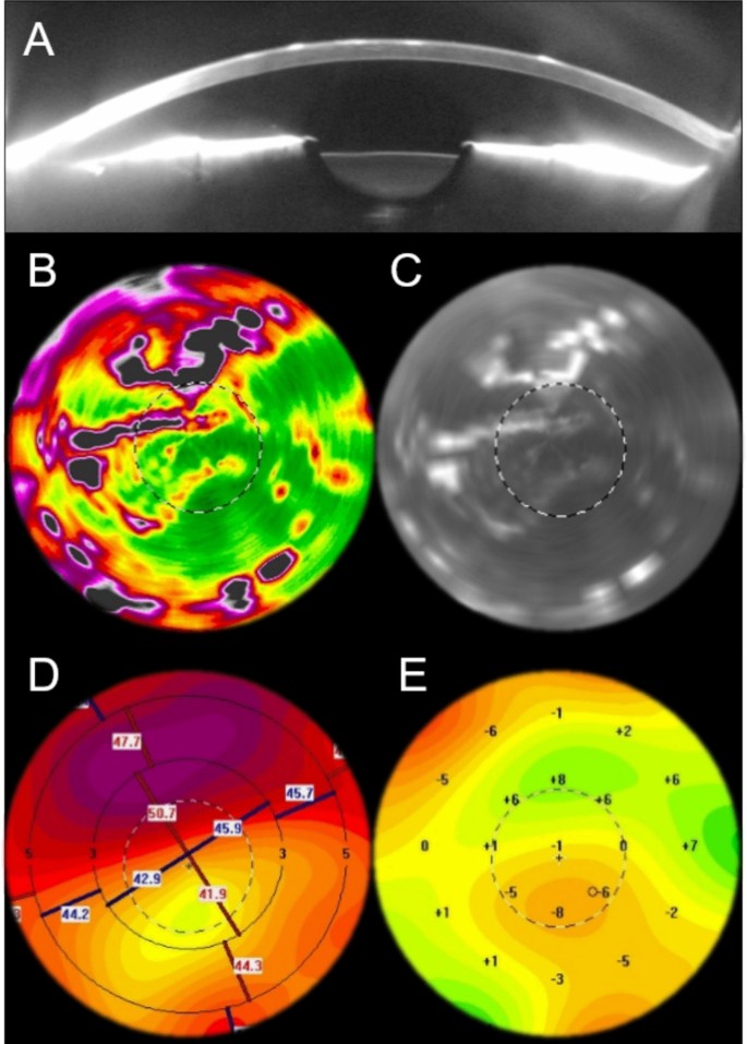 Analysis of corneal wavefront aberrations and corneal densitometry in ...