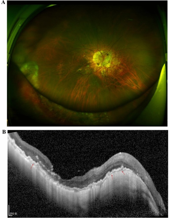 Rhegmatogenous retinal detachment associated with spontaneous ...