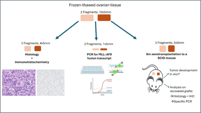 Cryopreserved ovarian tissue autotransplantation in an acute myeloid ...