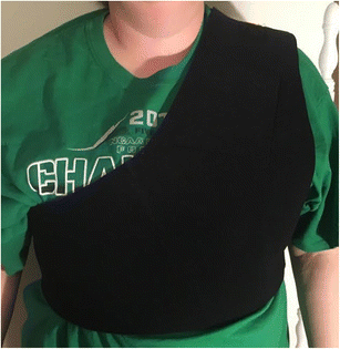 Use Of A Pocket Compression Device For The Prevention And Treatment Of Pocket Hematoma After Pacemaker And Defibrillator Implantation Stop Hematoma I Springerlink