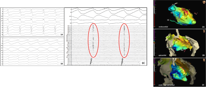 advisor hd grid mapping catheter
