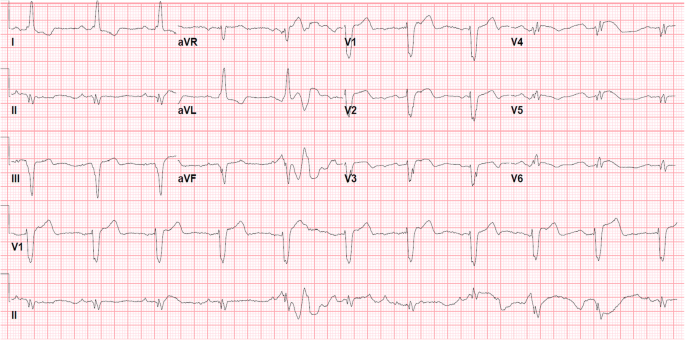 Bundle Branch Reentrant Ventricular Tachycardia Review And Case Presentation Springerlink