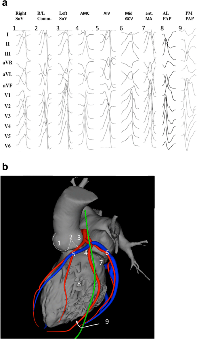 High Resolution Mapping of the Coronary Sinus to Determine Target Site for  Ablation in a Patient with VT Originating from the LV Summit