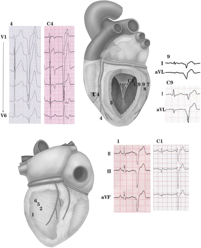 Eccentric Activation Patterns in the Left Ventricular Outflow Tract during  Idiopathic Ventricular Arrhythmias Originating From the Left Ventricular  Summit