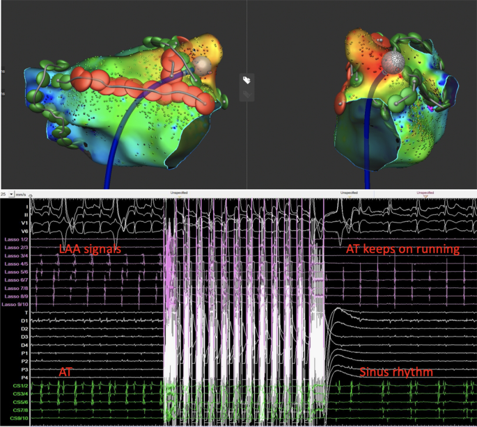 Pfa Rfa Durable LAA isolation combining pulsed field ablation and ...
