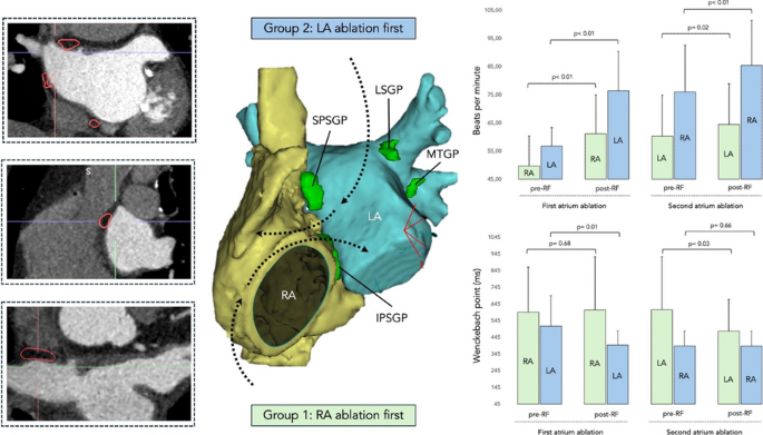Differential and synergistic effects of right and left atrial ...