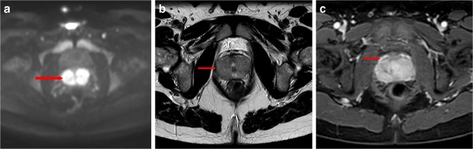 Prostatitis a CT- n