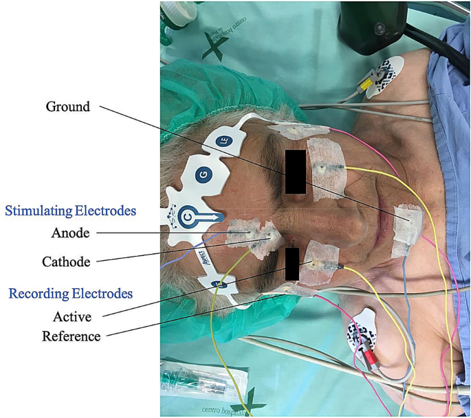 Electromyographic Assessment Of Blink Reflex Throughout The Transition From Responsiveness To Unresponsiveness During Induction With Propofol And Remifentanil Springerlink