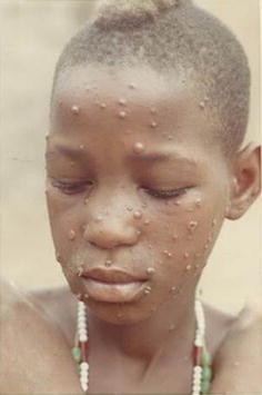 Clinical Manifestations of Waardenburg Syndrome in a Male Adolescent in  Mali, West Africa | SpringerLink