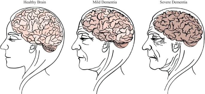 dementia research paper figure 1