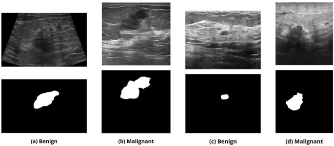 A Dual-stage Deep Learning Framework for Breast Ultrasound Image ...