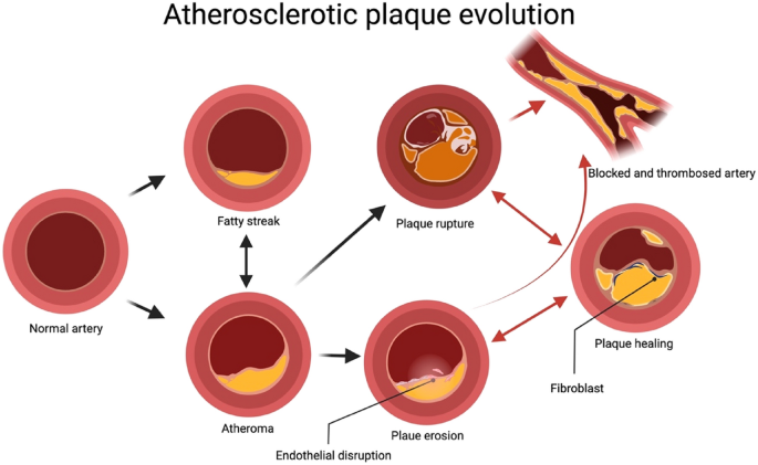 Residual risks and evolving atherosclerotic plaques | SpringerLink