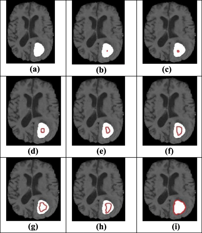 Morphological Edge Detection And Brain Tumor Segmentation In Magnetic Resonance Mr Images Based On Region Growing And Performance Evaluation Of Modified Fuzzy C Means Fcm Algorithm Springerlink Morphological Edge Detection And Brain Tumor Segmentation In Magnetic Resonance Mr Images Based On Region Growing And Performance Evaluation Of Modified Fuzzy C Means Fcm Algorithm Springerlink