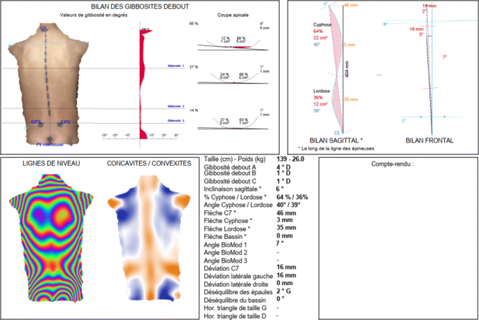 Rgb Topography And X Rays Image Registration For Idiopathic Scoliosis Children Patient Follow Up Springerlink
