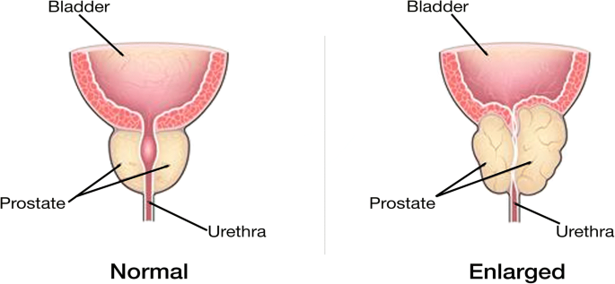 Vica- wook prostatitis