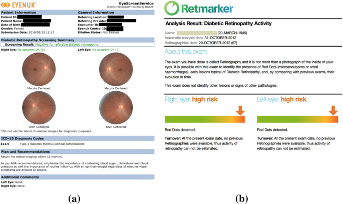 Diabetic eye sentinel: prescreening of diabetic retinopathy using retinal  images obtained by a mobile phone camera | SpringerLink