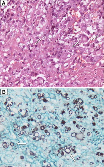 paracoccidioidomycosis histology