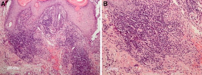 Isolated Cutaneous Granuloma Caused by Candida glabrata: A Rare Case Report  and Literature Review | SpringerLink