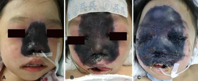 From The Pharynx To The Brain A Case Of Rapidly Progressing Mucormycosis Springerlink