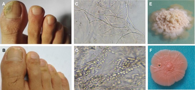 Mixed Infection of Toe Nail Caused by Trichosporon asahii and Rhodotorula  mucilaginosa | SpringerLink